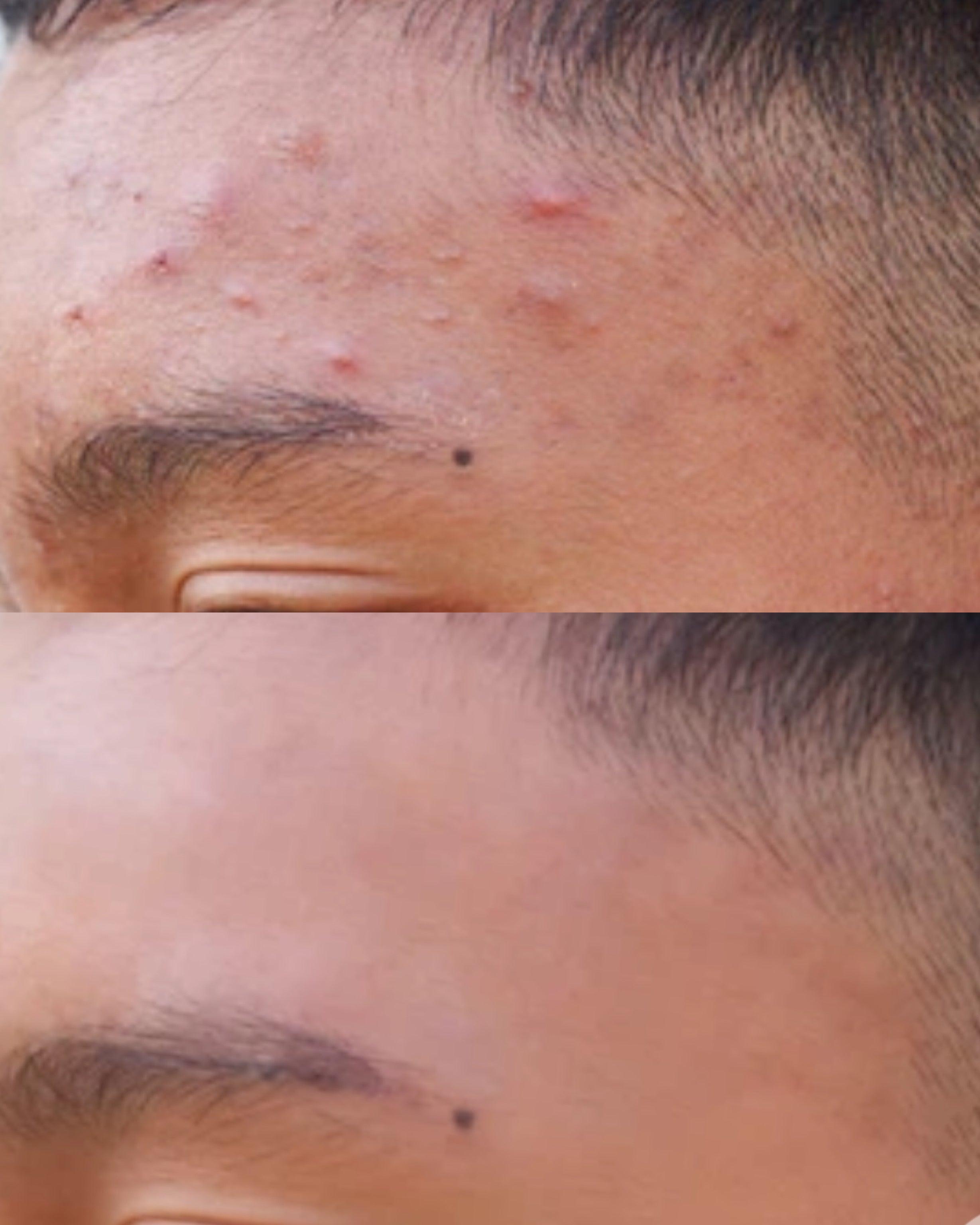 KIT OIL CONTROL para pele oleosa mista ou acneica、mySite、camillekostekn