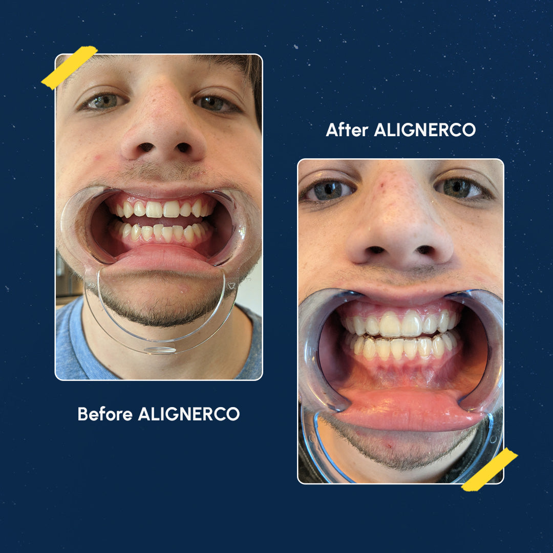 CouplesAdvantage - NightOnly Clear Aligners、mySite、gigharbornorthrealestate