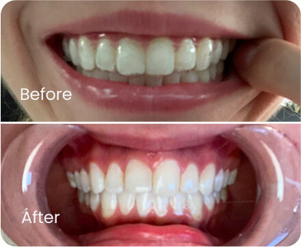 Overbite