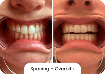 Overbite Overbite