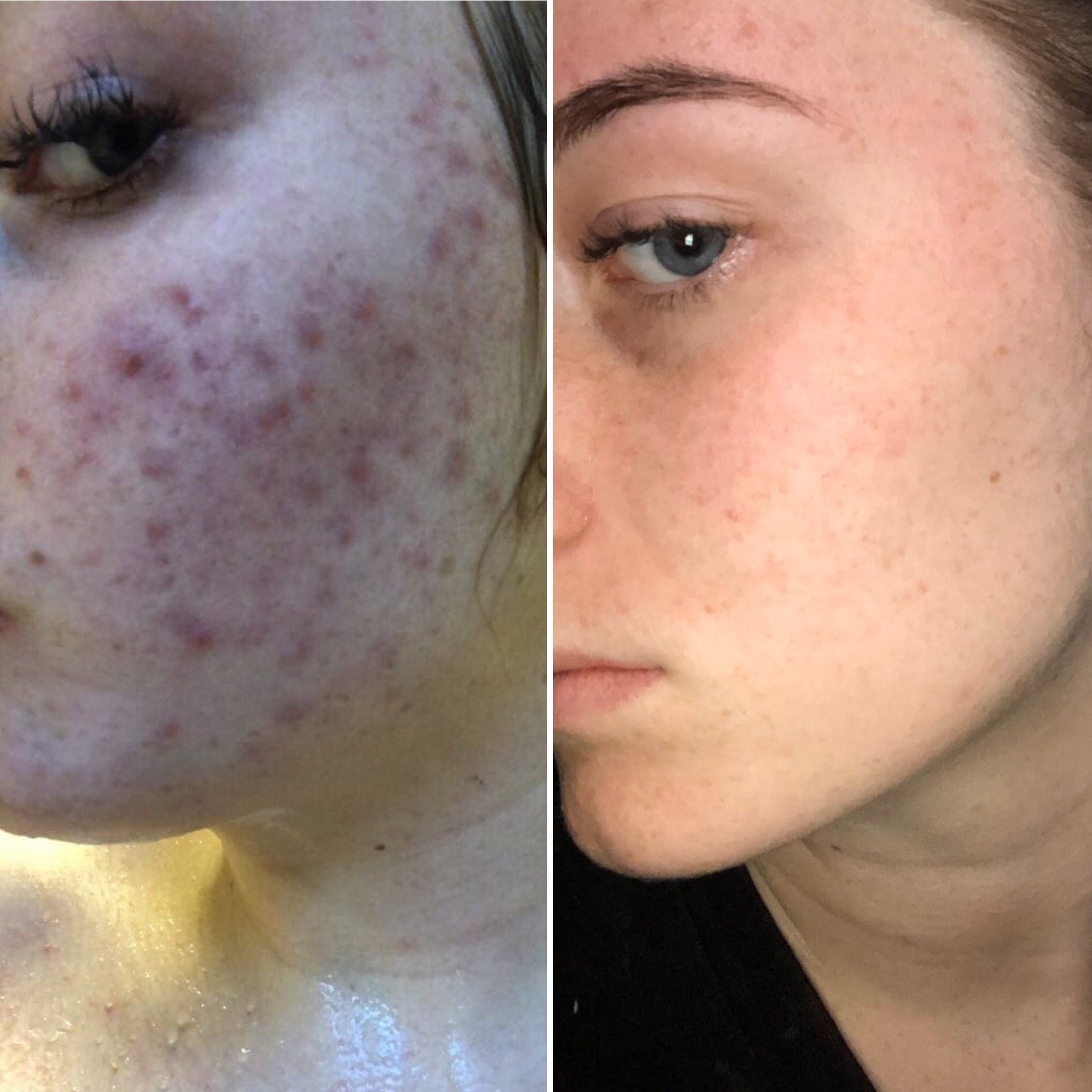  Acne / Combination Skincare Ritual、mySite、elrpsem3k