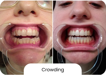 crossbite crossbite